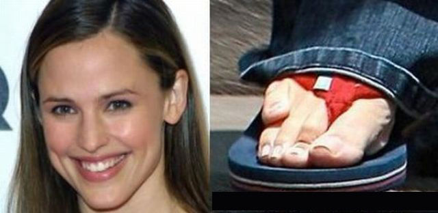 seleb yang miliki cacat  © 2017 berbagai sumber