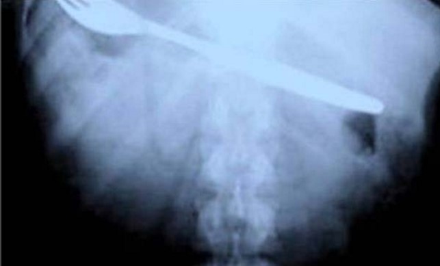 hasil xray © 2017 brilio.net hasil xray © 2017 brilio.net