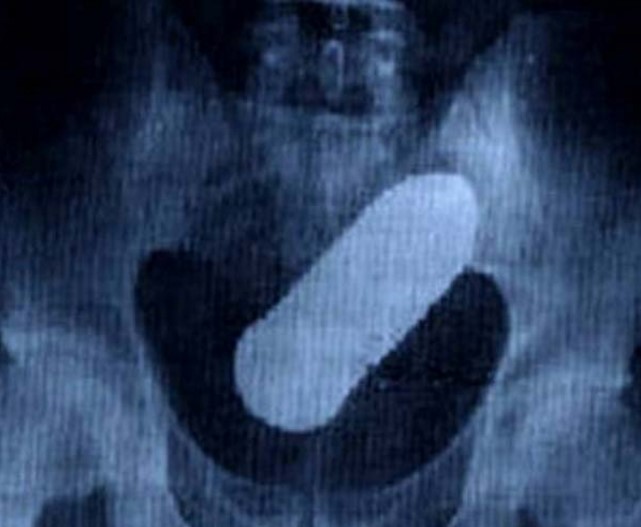 hasil xray © 2017 brilio.net hasil xray © 2017 brilio.net