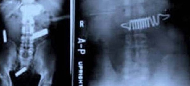 15 Benda aneh yang pernah tertangkap X-Ray dari tubuh manusia, ngeri