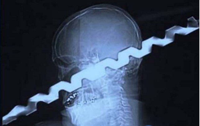 hasil xray © 2017 brilio.net hasil xray © 2017 brilio.net