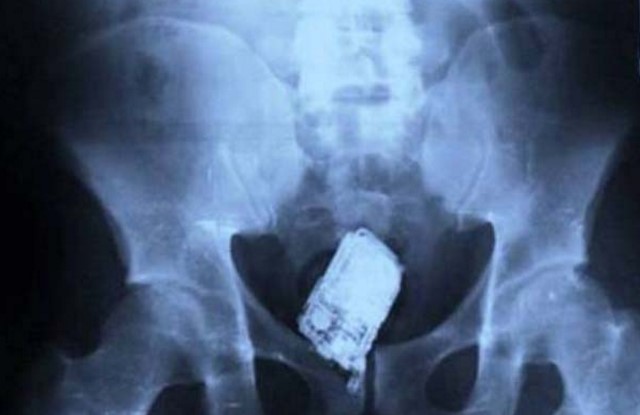 hasil xray © 2017 brilio.net hasil xray © 2017 brilio.net