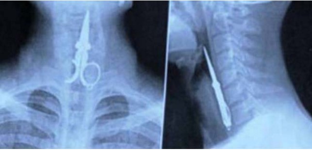 15 Benda aneh yang pernah tertangkap X-Ray dari tubuh manusia, ngeri
