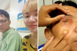 Mata pria ini jadi buta gara-gara pakai lensa kontak saat tidur