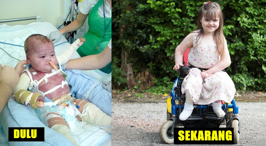 Divonis peluang hidup 5%, bocah ini bertahan usai jalani 340 operasi