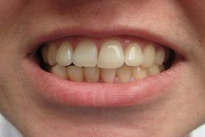 Gigi kuning terbukti lebih kuat ketimbang gigi putih, ini alasannya