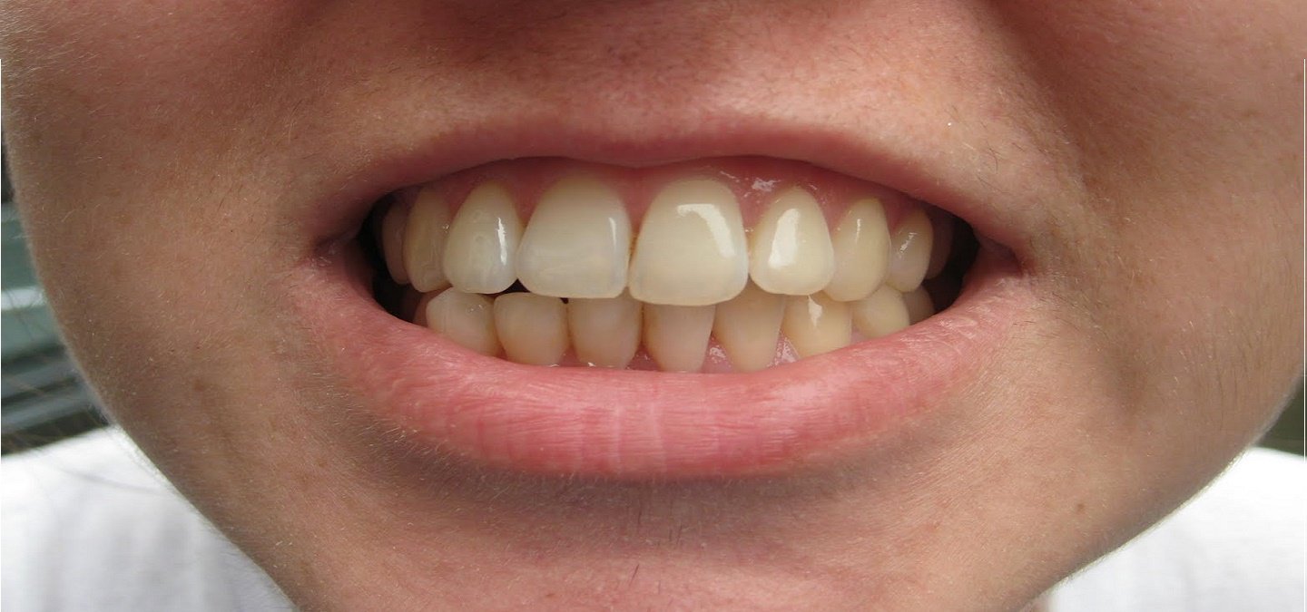 Gigi kuning terbukti lebih kuat ketimbang gigi putih, ini alasannya