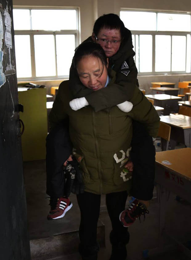 Mei Xiao penyakit  epidermolysis bullosa © 2017 dailystar.co.uk