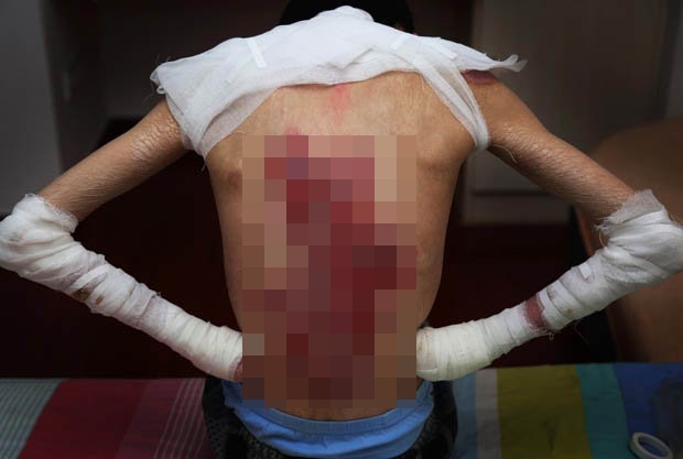 Mei Xiao penyakit  epidermolysis bullosa © 2017 dailystar.co.uk