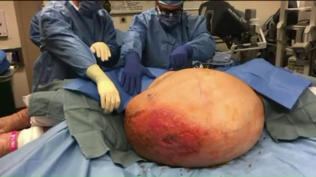 Selalu gagal diet, ternyata wanita ini derita tumor seberat 63 kg