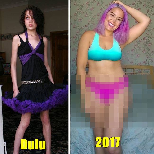 13 Potret pemulihan anoreksia ini bukti sehat lebih penting dari diet