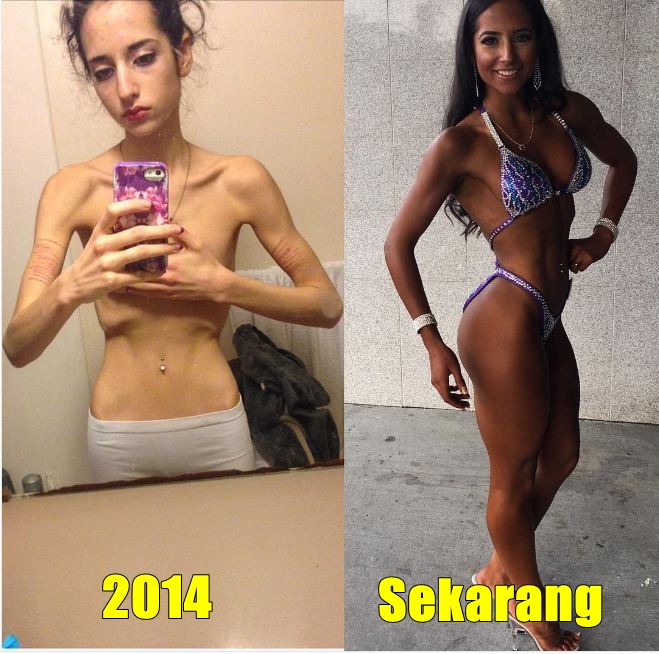 13 Potret pemulihan anoreksia ini bukti sehat lebih penting dari diet