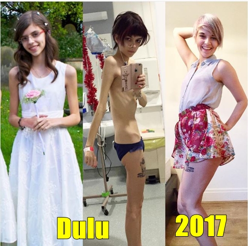 13 Potret pemulihan anoreksia ini bukti sehat lebih penting dari diet