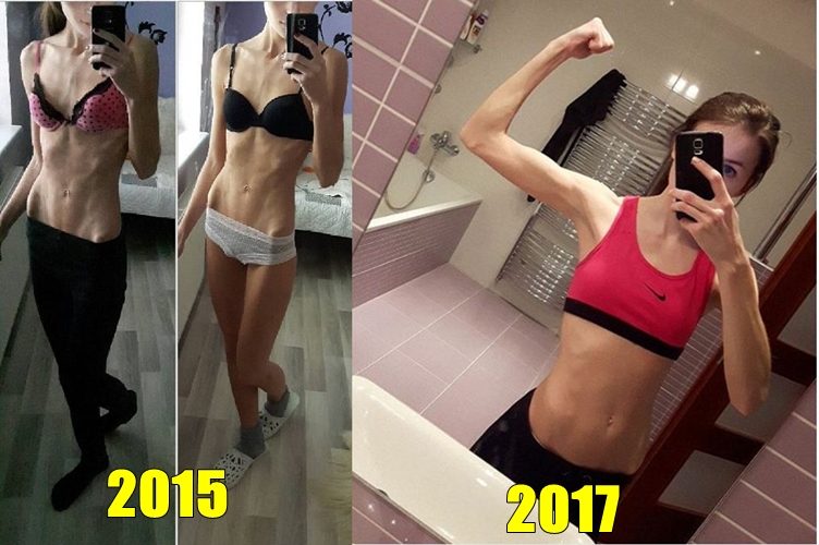 13 Potret pemulihan anoreksia ini bukti sehat lebih penting dari diet