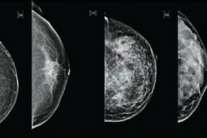 Tak disangka, obat diabetes bisa bantu atasi kanker payudara