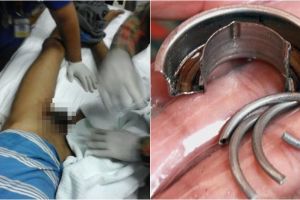 Cincin terjebak di Mr P, pria ini harus menahan sakit selama 12 jam
