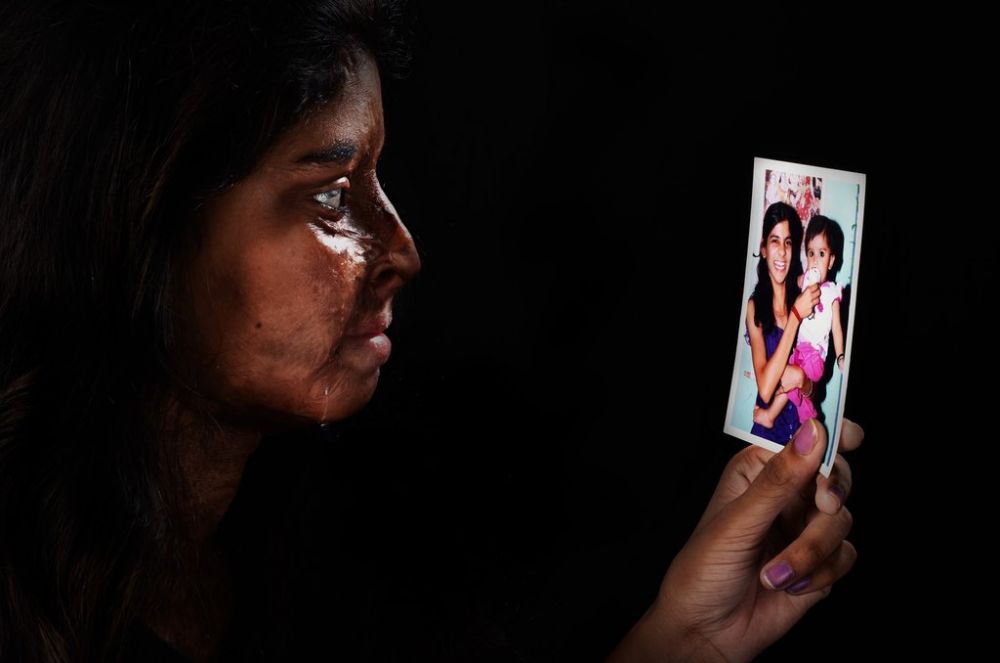 15 Potret menyentuh korban siraman air keras, bukti hati wanita kuat