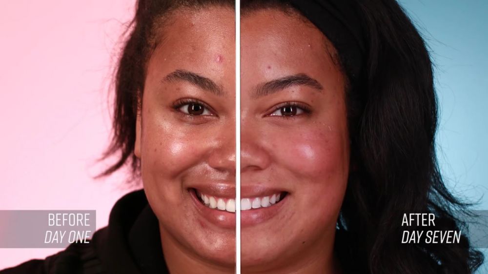 Before-after cewek pakai skin care Korea selama seminggu, hasilnya wow