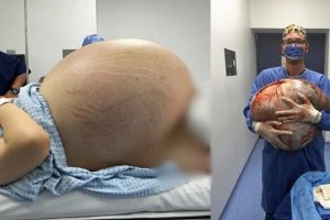 12 Foto ini tunjukan proses operasi kista sebesar 33 kg, menegangkan!