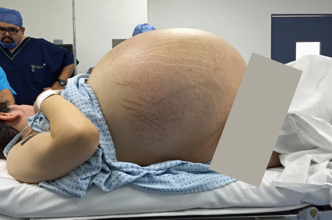 12 Foto ini tunjukan proses operasi kista sebesar 33 kg, menegangkan!