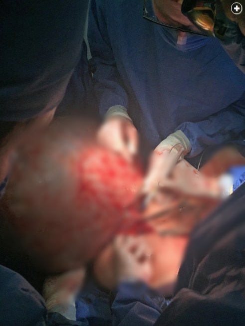 12 Foto ini tunjukan proses operasi kista sebesar 33 kg, menegangkan!