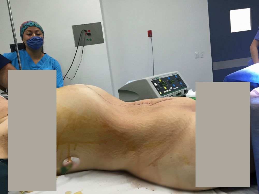 12 Foto ini tunjukan proses operasi kista sebesar 33 kg, menegangkan!