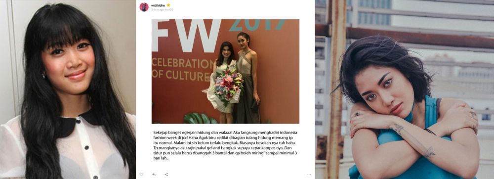 5 Seleb ini pernah pakai filler demi penampilan, gimana perubahannya?