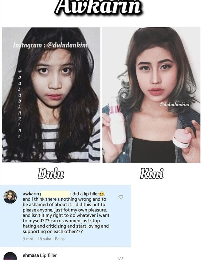 5 Seleb ini pernah pakai filler demi penampilan, gimana perubahannya?