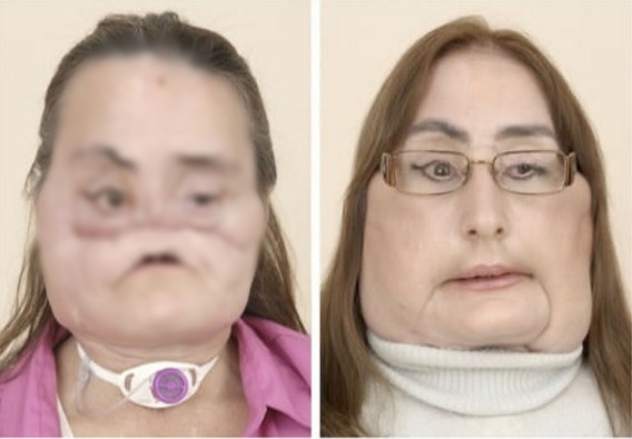11 Foto before-after hasil face off ini bukti kehebatan dunia medis