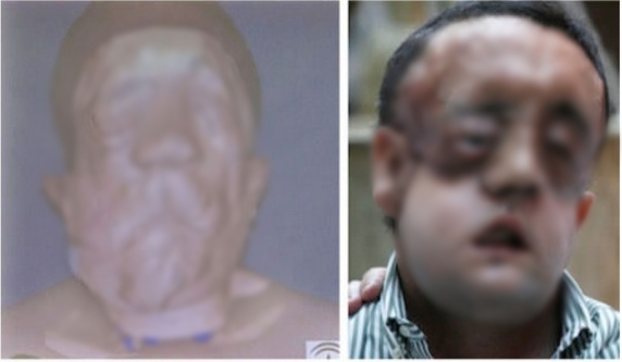 11 Foto before-after hasil face off ini bukti kehebatan dunia medis