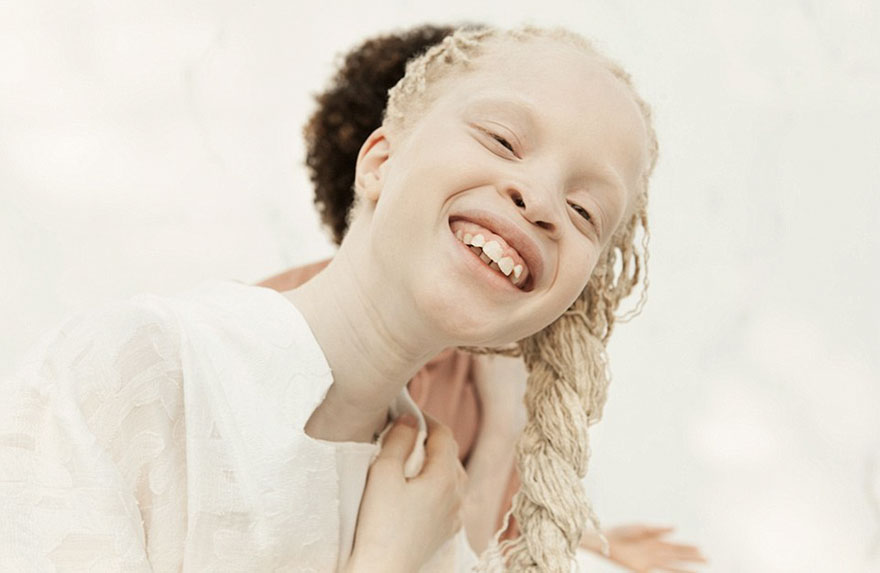 Gadis kembar ini buktikan albino punya pesona kecantikan alami