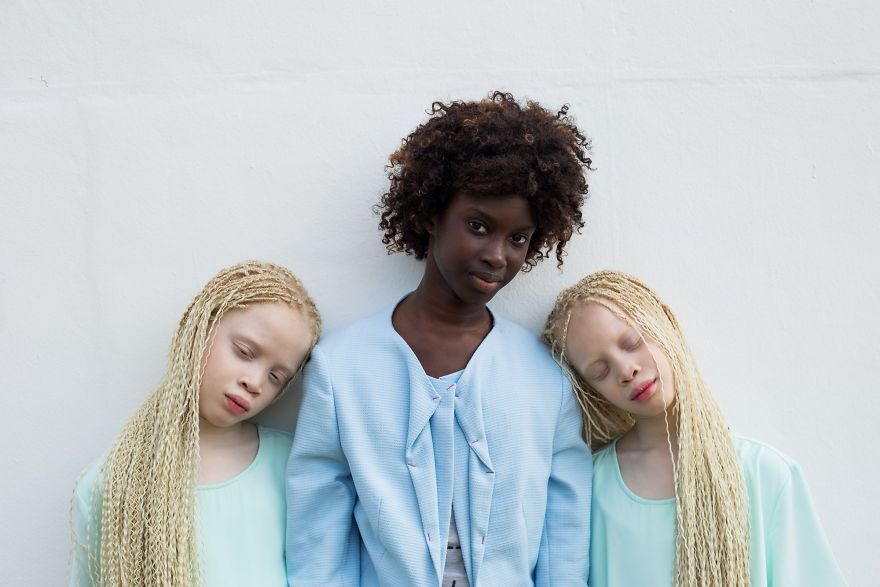 Gadis kembar ini buktikan albino punya pesona kecantikan alami