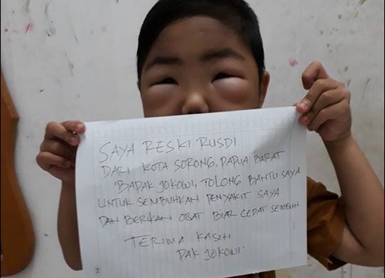 Idap sindrom nefrotik, bocah ini bikin video untuk Presiden Jokowi