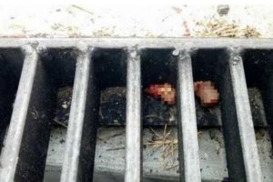 Remaja ini kehilangan dua jarinya karena mengambil dompet, kok bisa?