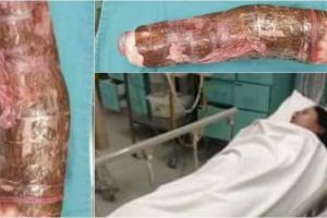 Pakai singkong sebagai alat bantu seks, nasib wanita ini malah apes