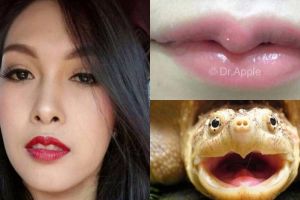 Ikuti tren, cewek ini rela bayar 13 jutaan demi bibir mirip kura-kura