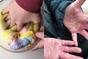 Ingin membuat slime sendiri, tangan bocah ini malah mengelupas