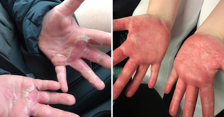 Ingin membuat slime sendiri, tangan bocah ini malah mengelupas