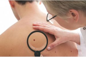 7 Tanda awal penyakit kanker kulit yang sebaiknya kamu ketahui