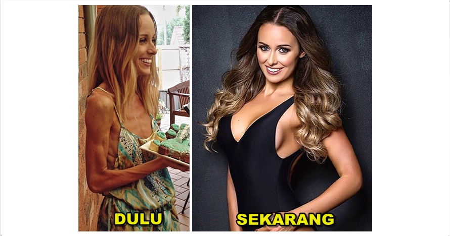 20 Foto before after cewek derita anoreksia, usai sembuh jadi cantik