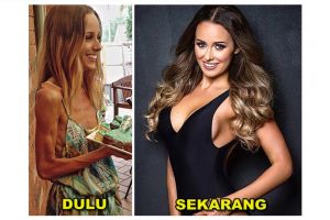 20 Foto before after cewek derita anoreksia, usai sembuh jadi cantik