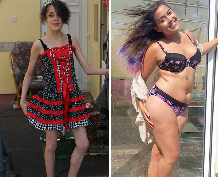 20 Foto before after cewek derita anoreksia, usai sembuh jadi cantik