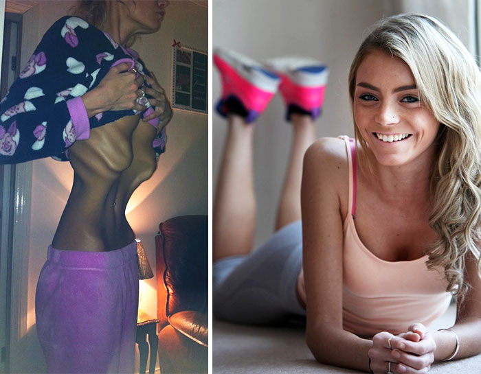20 Foto before after cewek derita anoreksia, usai sembuh jadi cantik