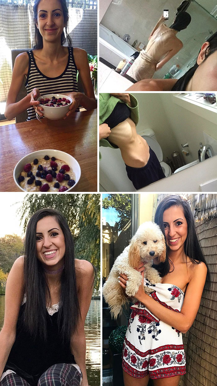 20 Foto before after cewek derita anoreksia, usai sembuh jadi cantik