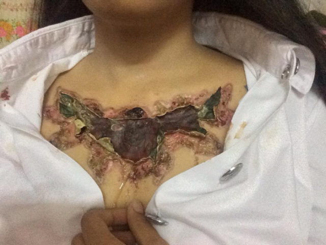 Niat hapus tato, nasib kulit wanita ini malah mengerikan