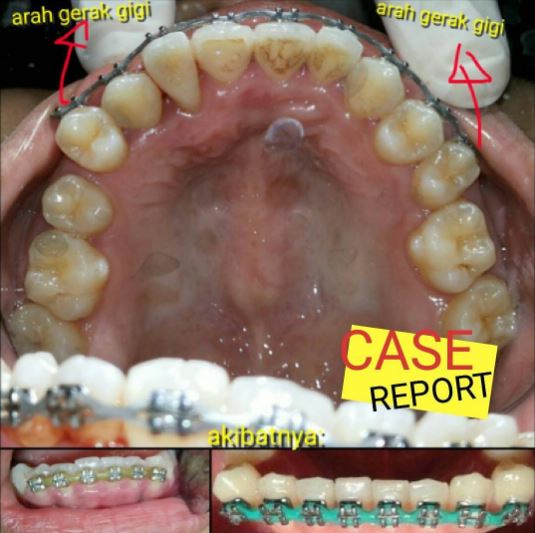 7 Foto mengerikan akibat perawatan gigi di praktik ilegal, serem lho 