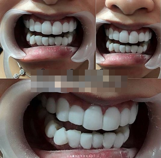 7 Foto mengerikan akibat perawatan gigi di praktik ilegal, serem lho 