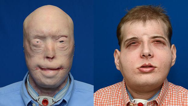 6 Foto before-after transplantasi wajah ini bukti canggihnya medis