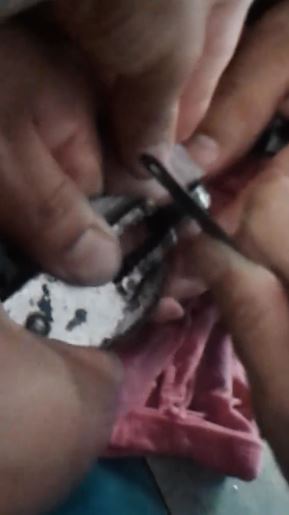 Fidget Spinner nyaris membuat balita ini kehilangan jarinya