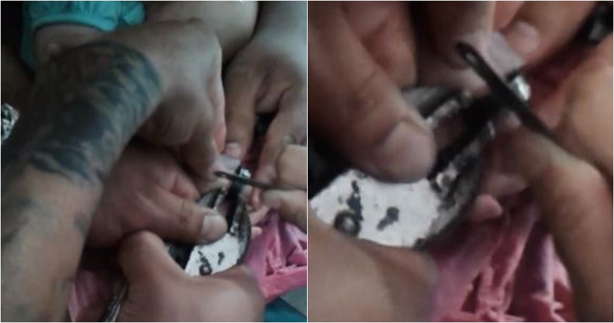 Fidget Spinner nyaris membuat balita ini kehilangan jarinya